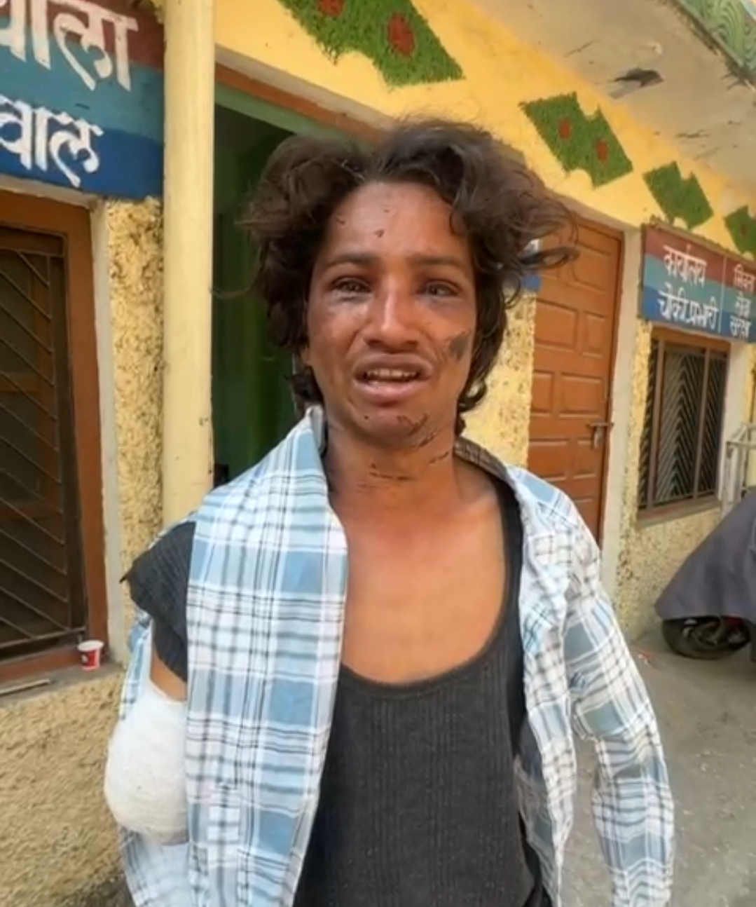 पारिवारिक विवाद में भाई और भाभी की क्रूरता आयी सामने, गंवाएं दोनों हाथ।